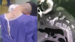 Sindrom Kepala Jatuh: Leher Bengkok, Otot Melemah, Bahaya!