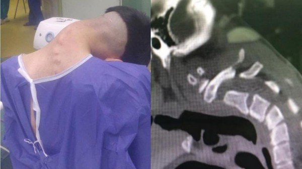 Sindrom Kepala Jatuh: Leher Bengkok, Otot Melemah, Bahaya!